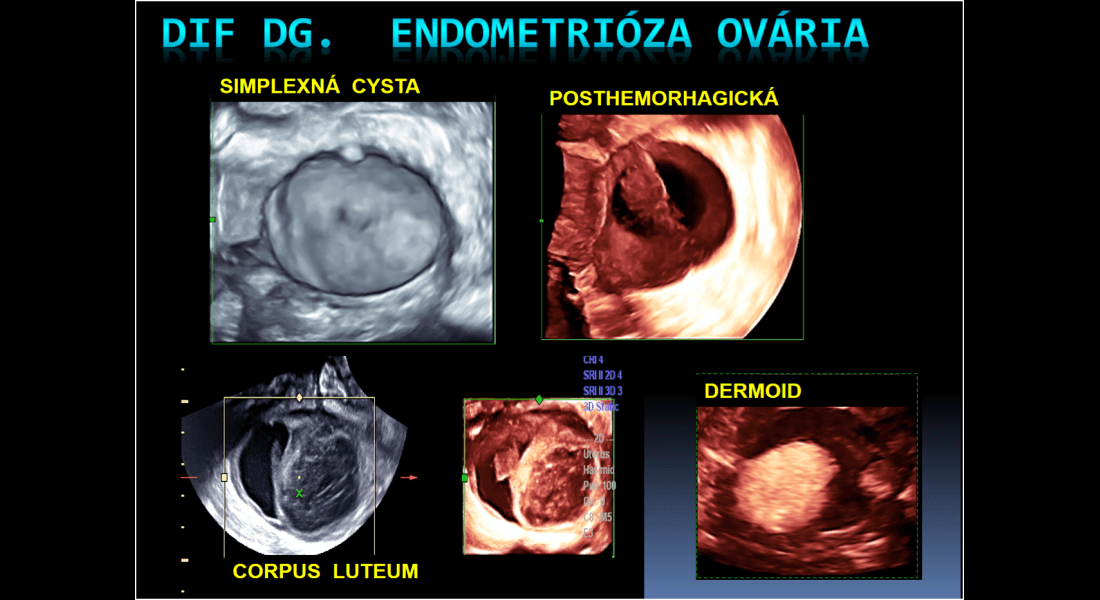 DIF. DG Endometrióza ovária