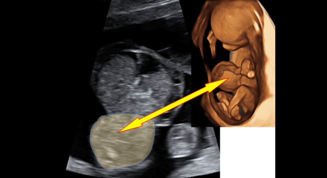 Herniácia v mieste vstupu pupočnej šnúry - omphalokéla. 3D obrázok omphalokély v 13. týždni tehotnosti.