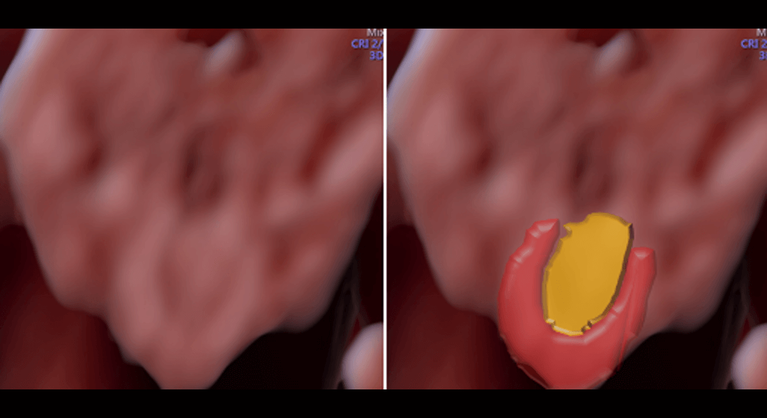 3D HD live rekonštrukcia podnebia (žltá farba) a budúceho zubného oblúka (červená).