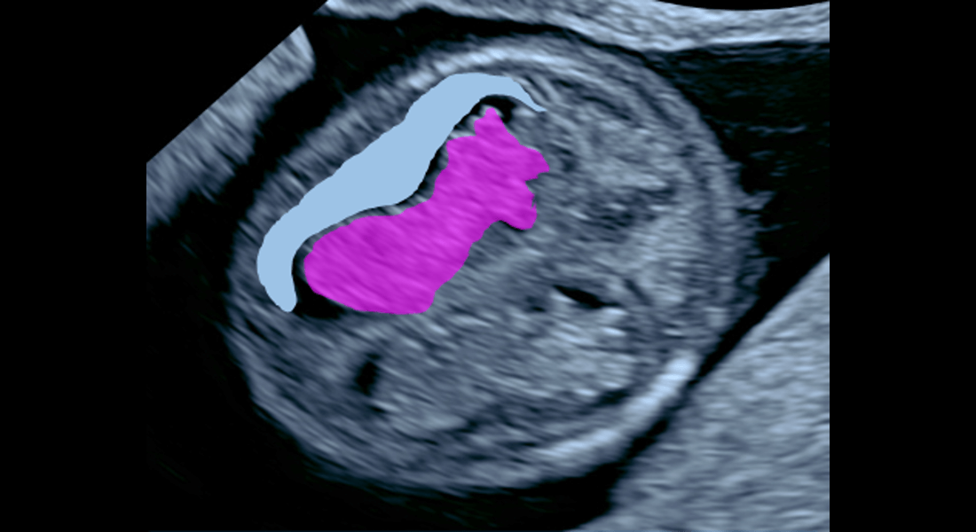 Dominantná štruktúra – plexus chorioideus (fialová farba). Kôrová časť mozgu je len tenký lem (bledomodrá farba)