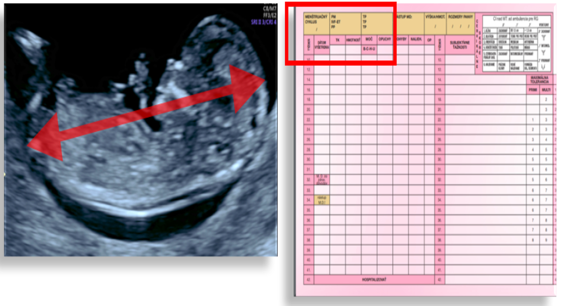 Meranie vzdialenosti medzi kostrčou a hlavičkou /CRL/ = exaktné stanovenie termínu pôrodu +- 4 dni