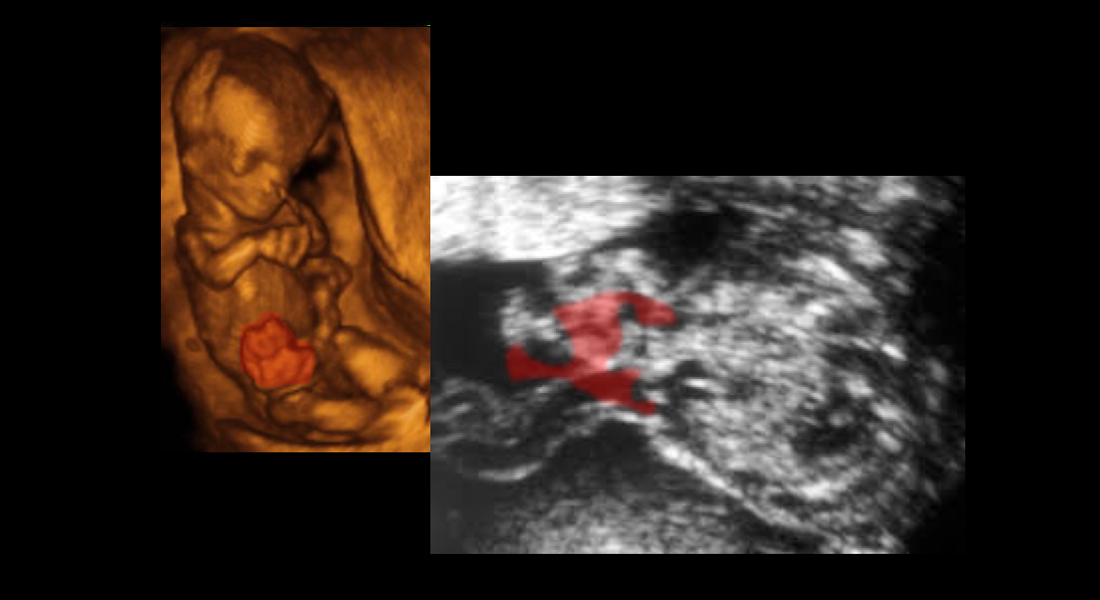 Herniácia črevných kľučiek vpravo od miesta vstupu pupočnej šnúry – gastroschíza 2D vs. 3D obrázok” title=